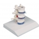 VERTEBRES LOMBAIRES DEMONTABLES AVEC HERNIE 