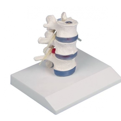 VERTEBRES LOMBAIRES DEMONTABLES AVEC HERNIE 